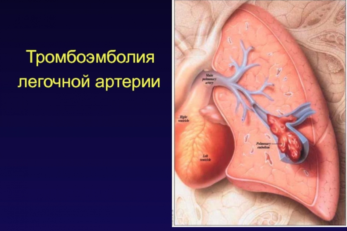 Как защитить себя и снизить риск тромбозов