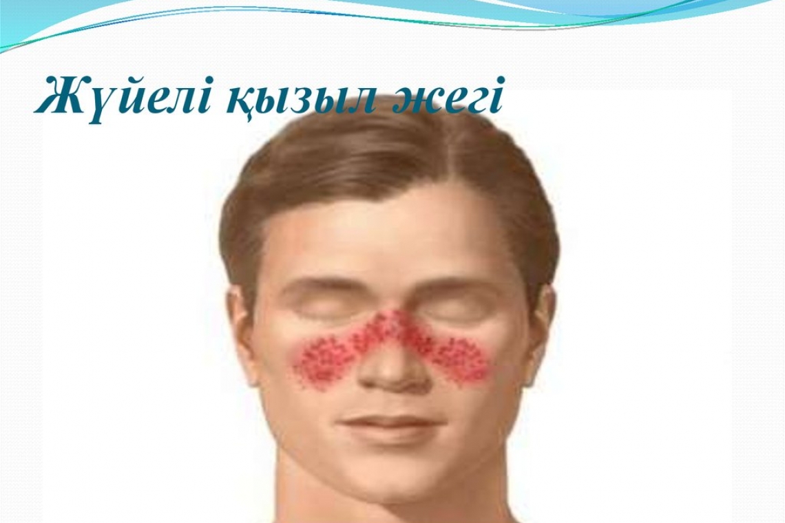 Жүйелі қызыл жегі дертіне шалдыққан әйелдерге жүктілікті қалай жоспарлауға болады?